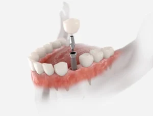 An illustration of a dental implant in a lower jaw, showing the gum and teeth. The metal implant is being fitted with a crown, highlighting dental restoration.