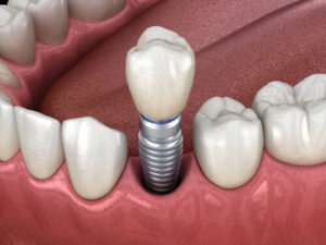 Dental Implants for Pensioners procedure