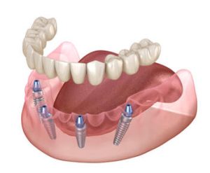 all-4-dental-implants-cost-illustration-elanora