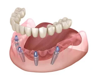 Rendering of a dental implant model showing a lower jaw with four metal implants, supporting a full arch of teeth. The tone is clinical and informative.