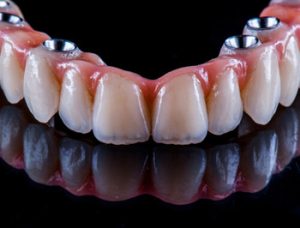 All on 4 Dental Implants cost factors elanora coorparoo
