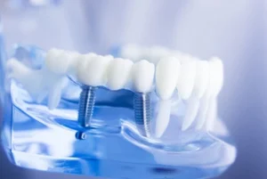 A dental model showcasing two metal implants embedded in the lower jaw, surrounded by white artificial teeth. The background is softly blurred in blue tones.