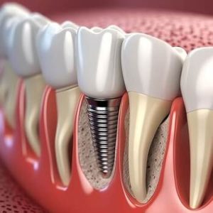 Single Tooth Implant Cost Australia image coorparoo