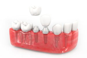 single tooth implant cost australia number of teeth coorparoo