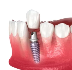 Illustration of a dental implant in the lower jaw, showing a metallic screw embedded in the gum below a tooth crown amidst healthy teeth.