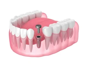 3D illustration of a dental implant in a lower jaw model showing teeth, gums, a metal implant, and an abutment screw, against a white background.