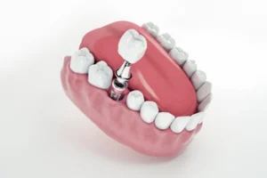 Dental model showing a dental implant inserted into the gum, surrounded by white teeth. The implant consists of a metal post topped with a crown.