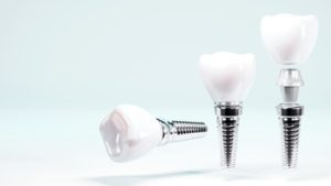 teeth implant thailand coorparoo