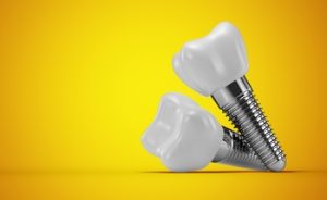 tooth implant overseas coorparoo