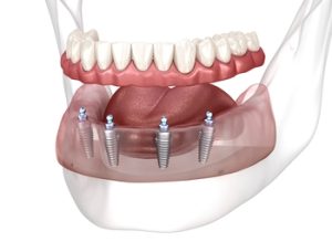complete dental implants costs coorparoo