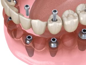 full mouth dental implants value coorparoo