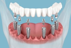 implant dentist full mouth expenses coorparoo