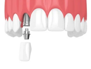 Illustration of dental implant procedure showing a metal implant in the gum, aligning with a detached artificial tooth below, set against a white background.