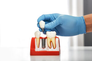 cheap dental implant reasons