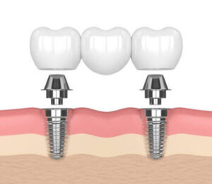 Dental Implants Vs Bridge comparison