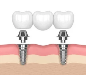 Illustration of dental implants with metal posts anchored in gum layers, topped with white crowns, showing the process of tooth replacement.