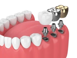 3D illustration of dental implants in gums, with various crowns including white, silver, and gold options. Shows implant abutments and missing teeth replacements.
