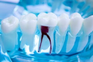 what is a root canal pulp