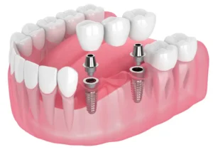 Rendering of a dental model showing two dental implants with abutments in the gums, surrounded by white teeth, illustrating dental restoration.