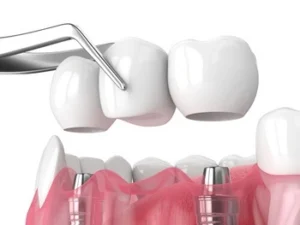Illustration of a dental bridge being placed over two metal implants on gums, with a dental tool holding the bridge. The scene conveys precision in dental care.