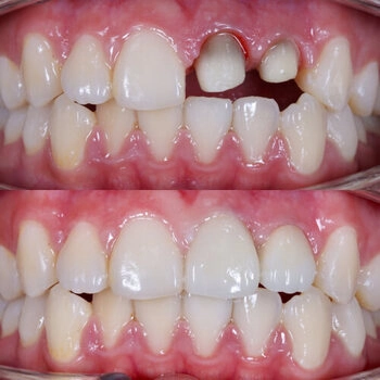 Before and after dental transformation showing upper front teeth. The top image has a missing tooth; the bottom image shows a complete smile with aligned teeth.