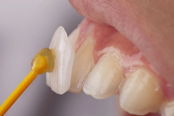 Close-up of a dental veneer being applied to a person's tooth using a small brush with adhesive. The scene is clinical and focused on cosmetic dentistry.