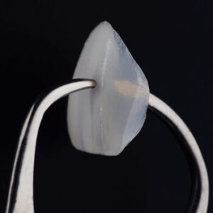 Porcelain Veneers Before and After shell