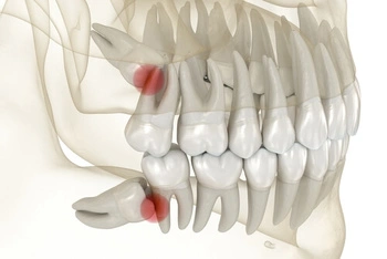 Dental X-ray showing an impacted lower wisdom tooth pushing against the adjacent molar, highlighted with a red spot to indicate problem areas.