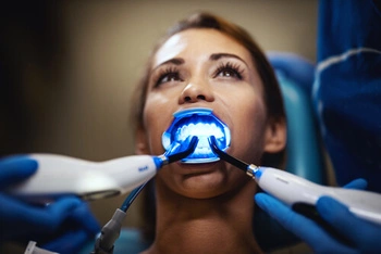 Woman receiving teeth whitening treatment, mouth open with a blue light device inside. Dental professionals in blue gloves working, creating a clinical atmosphere.