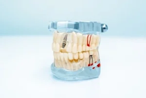 Maximum Time Between Bone Graft and Dental Implant illustration
