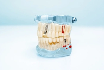 Dental model showing a set of artificial teeth, including a dental implant and highlighted nerves. Set on a light blue gradient background.