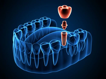 An illustration of a semi-transparent lower jaw with blue teeth and a highlighted red dental implant being inserted, on a dark background.
