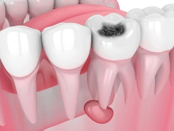 3D illustration of human teeth showing a tooth with severe decay featuring a large black cavity. The surrounding gums appear healthy and pink.