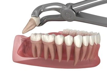 3D rendering of a dental extraction: forceps gripping a tooth being removed from a gum model, illustrating a dental procedure.
