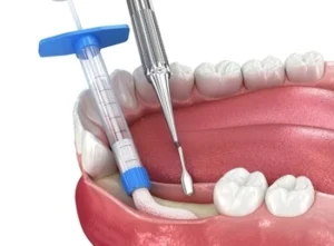 Dental Bone Graft Recovery procedure