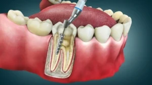 illustration of how root canal treatment happens
