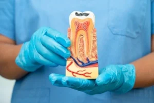 illustration of tooth with decay