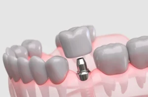 Anatomical diagram showing the difference between a healthy tooth and a dental implant.