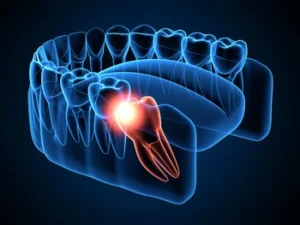 impacted wisdom tooth illustration