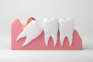 impacted wisdom tooth trying to erupt