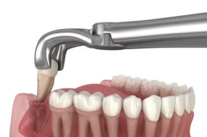 broken molar tooth extraction