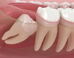 partial eruption of wisdom tooth